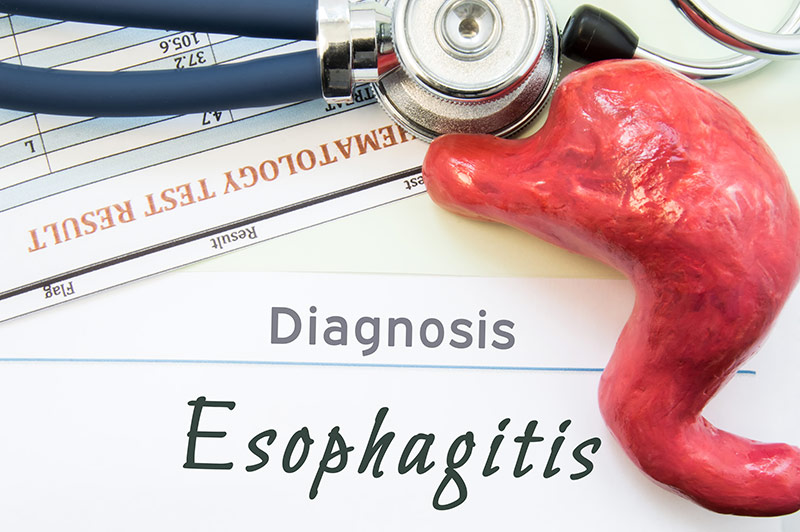 Erosive Esophagitis Clinical Study
