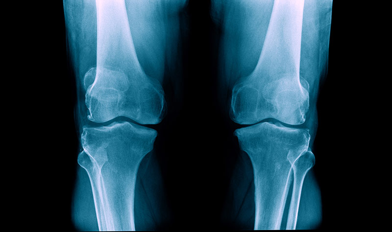 OA of the Knee Clinical Study